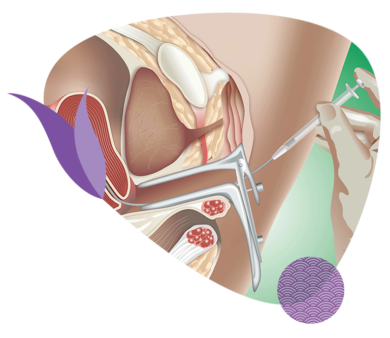 Inseminação intrauterina